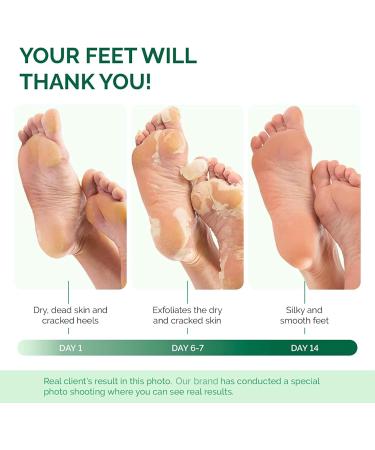 Niacinamide Serum Foot Peel Mask (3 Pairs) - Feet Peeling Mask For Baby Soft Skin Remove Dead Skin Dry Cracked Feet & Callus Spa Hard Skin Remover Foot For Women And Men Peeling Exfoliating Socks - Buy Online on GoSupps.com