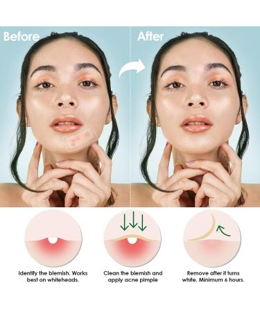 Buy NiHealth Large Tea Tree Oil Acne Pimple Patch - Hydrocolloid Blemish Cover | 25mm & 60mm (10 Counts) | Fast International Shipping - Buy Online on GoSupps.com