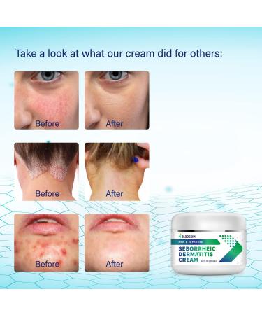 Seborrheic Dermatitis Cream - Fast-Acting Treatment for Face, Scalp, Folliculitis, Dandruff, Psoriasis - 3.4 oz - Buy Online on GoSupps.com