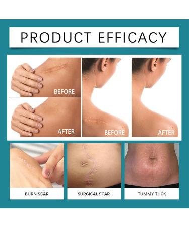  Iouyjiu Scar Cream Burn Repair Skin Healing Intensive Overnight Formula Protective Care Support Tube for Face Tummy Body Arms Legs Women Men Burn Injury Recovery 50ml - Buy Online on GoSupps.com