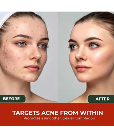 Acne Cleanse Capsules.Powerful Vitex Angus Extract, Niacinamide, Biotin for Teens & Adults. Organic Acne Treatment,Cystic Pimples, Oily Skin to Natural Clear Skin Vitamins Supplement- 60 Count - Buy Online on GoSupps.com
