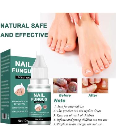 Fungal Nail Treatment - Extra Strong Solution for Toenail Fungus & Ingrown Toenails (10ML) - Buy Online on GoSupps.com