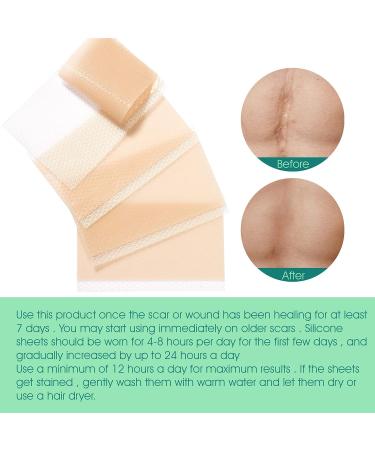 Silicone Scar Sheets - Surgical/Burn Scar Removal Treatment - 4PCs - Buy Online on GoSupps.com