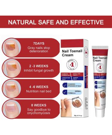 Fungal Nail Treatment Cream Antifungal Nail Polish Cream Nail Fungus Treatment for Toenail Strong Anti-Fungal Toenail Cream Nail Improve Cream Nail Repair Cream for Thick Cracked Discolored Nails - Buy Online on GoSupps.com