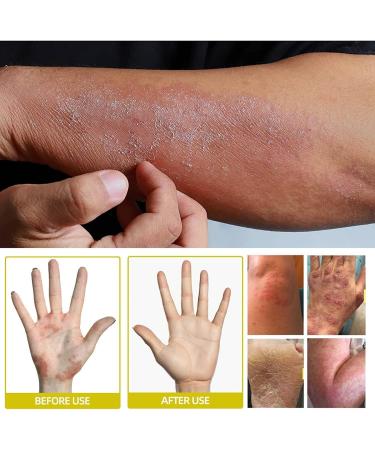 Anshka Herbal Tinea Corporis Cream - Gentle Relief for Tinea Skin Itching (3pcs) - Buy Online on GoSupps.com