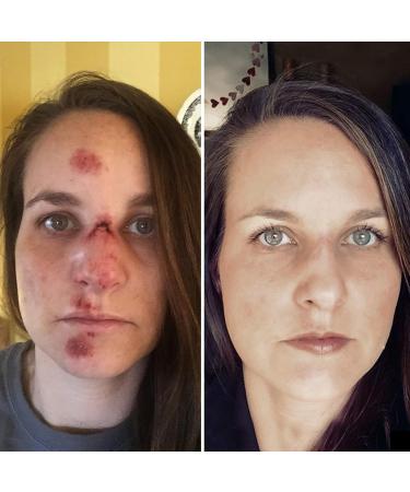 Brave Soldier Antiseptic Healing Ointment 1oz - Tea Tree Oil Cream for Wounds & Burns - Buy Online on GoSupps.com