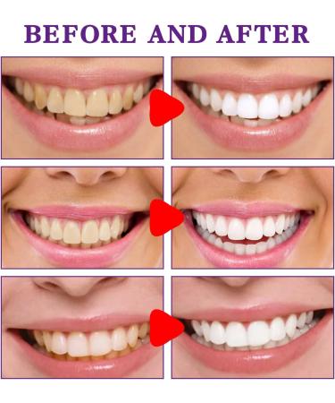 KLYso Color-Correcting Teeth Whitening Toothpaste - Stain Removal & Fresh Breath(1PCS) - Buy Online on GoSupps.com