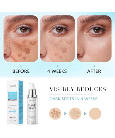 Dark Spot, Dark Spot Remover for Face and Body with Niacinamide & Alpha-Arbutin | Serum for Age Spots, Sun Spots, Melasma | All Skin Types, Men & Women 1 Fl Oz (Pack of 1) - Buy Online on GoSupps.com