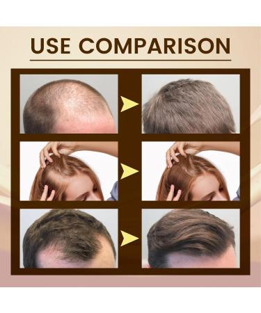 5% Biotin Minoxidil Hair Growth Oil 5% Minoxidil for Men and Women Hair Growth Serum Minoxidil Biotin Hair Growth Serum Nourishes Scalp Stops Hair Loss & Thinning 20ml (100ml) - Buy Online on GoSupps.com