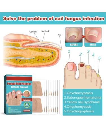 2024 New 3Boxes/48pcs Anti Fungus Nail Treatment Patches Toe Fungus Onychomycosis Repair Sticker Nail Patches - Buy Online on GoSupps.com