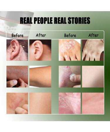 All-Natural Eczema & Psoriasis Cream for Sensitive Skin | Herbal Anti-Itch Lotion for Dermatitis, Shingles, Acne & Rosacea | Soothing Moisturizer for Dry, Itchy Skin (1.06oz & 5.50oz Options) - Buy Online on GoSupps.com
