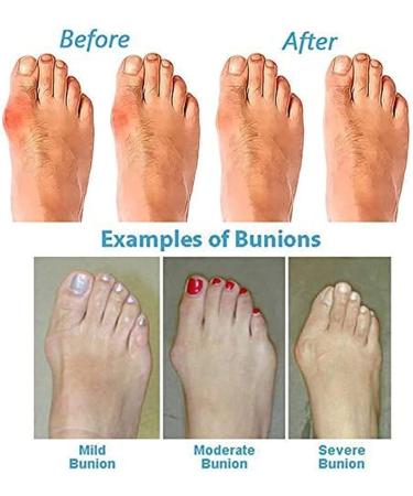 Bunion Splints Platform Sandal - Hallux Valgus & Plantar Fasciitis Corrector Slippers (Black Size 7) - Comfort & Support - Buy Online on GoSupps.com