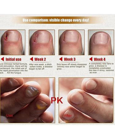 Durcisseur et fortifiant pour Ongles | Mycoses Solution Extra Forte pour Les Ongles - Patchs pour Ongles Anti-fongiques pour Le renouvellement des Ongles Force maximale pour Les - Buy Online on GoSupps.com