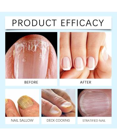 Nail Blue Light Device | Nail Cleaning Lamp Erase Toenail Discoloration Solution Damaged Discolored Nails Device Long Lasting Nail Care for Fingernails - Buy Online on GoSupps.com