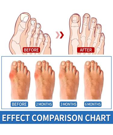 Best Bunion Corrector - Orthopedic Splint for Hallux Valgus & Hammer Toe - Men & Women Night Use - Buy Online on GoSupps.com