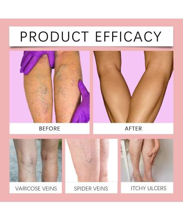  Orgrul Algae ointment for spider veins Varicose Vein Cream for spider veins varicose veins leg cream leg ointment care refreshment and relaxation of swollen legs and - Buy Online on GoSupps.com