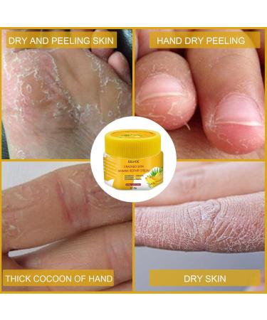Horn Skin Remover & Cup Ointment | Anti-Cornea & Dry Skin Foot Cream for Men & Women | Intensive Care for Cracked Skin - 2PCs Yellow - Buy Online on GoSupps.com