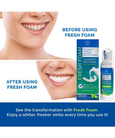 Aligner & Retainer Cleaner Foam Dry Mouth Relief, Compatible with Invisalign, Aligners, Retainers, Mouth Guards, Night Guards, Veneers, Whitens, Freshens, 3% Hydrogen Peroxide, Mint - 50ml, 2 PC Mint 1.7 Fl Oz (Pack of 2) - Buy Online on GoSupps.com
