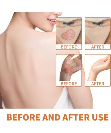 Bee Venom Psoriasis Cream - Bee Venom Psoriasis Cream New Zealand Bee Venom Cream Fast-Acting Relief Bee Venom Cream Psoriasis Cream Soothing Psoriasis Cream - Buy Online on GoSupps.com