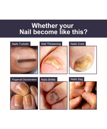 Nail Repair Oil Toe Nail Fungal Treatment Nail Fungus Treatment for Endophyt Nail Anti fungus Nail Repair and Strengthen Fix & Renew Damaged Broken Nails - Buy Online on GoSupps.com