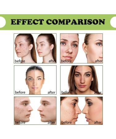 Acne Removing Facial Serum Natural Tea Tree Repairer Reduces Pimples and Blackheads for Acne and Oily Skin Moisturizing and Fine Pores for Women and Men 3 Pieces - Buy Online on GoSupps.com