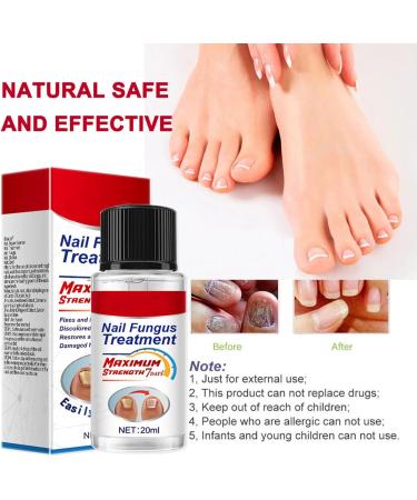 Extra Strong Fungal Nail Treatment 20ml - Premium Toenail and Fingernail Fungus Eliminator - Anti-Fungal Repair and Strengthening - 1 PCS - Buy Online on GoSupps.com