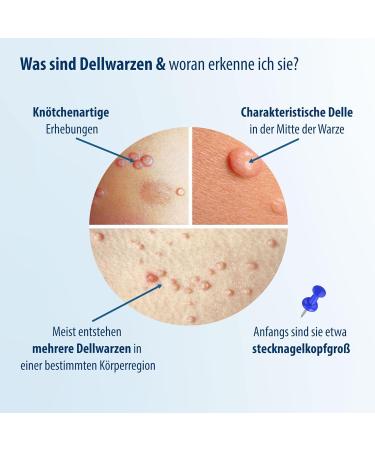 Evolsin Molluscum Warts Agent I For Adults & Children from 2 Years Gentle & Effective Molluscum Warts Treatment - 0.16 Oz - Buy Online on GoSupps.com