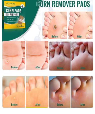 Max Strength Corn Remover Plaster - 24 Pads for Toes & Feet | Large & Small Sizes | Effective Corn Removal - Buy Online on GoSupps.com
