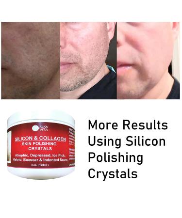 Clear Alka Vita Acne Scars Gel - Silicon & Collagen Crystals for Atrophic & Keloid Scars - 4.0 Fl Oz - Buy Online on GoSupps.com