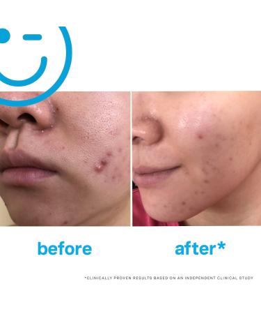 Kate Somerville Breakout Dream Team: EradiKate 3% Sulfur Daily Foaming Cleanser Acne Treatment 4 oz. and Mega-A Skin Transforming Anti-Aging Serum with Retinal 1 oz. - Buy Online on GoSupps.com