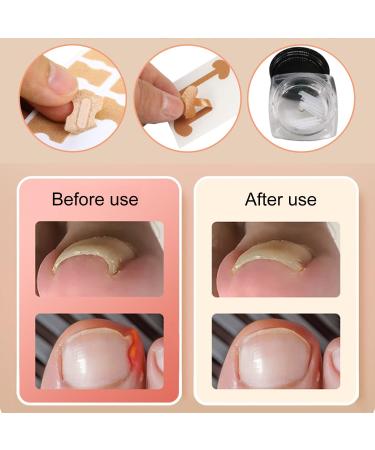 Ilamvie Ingrown Toenail Correction Set - 112 Piece C-Shaped Fill Padding Tool for Easy Ingrown Toenail Treatment - Buy Online on GoSupps.com