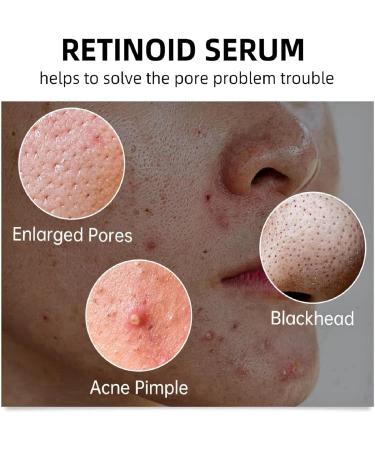 10% Niacinamide Serum + 1% Zinc Serum Moisturiser Face Serum Anti Aging Serum for Face Brightening Serum for Face Face Oils and Serums Control Excess Oil Dull Skin and Redness for All Skin Types - Buy Online on GoSupps.com