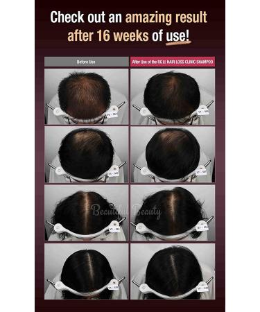 RGIII Premium Red Ginseng Hair Loss Prevention Shampoo & Treatment Set - Buy Online on GoSupps.com