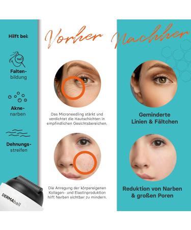 BS Luxry Premium Dermaball Microneedling Roller - 1200 Real Titanium Needles for Face Body & Hair - 0.5mm Scar Treatment at Home - Buy Online on GoSupps.com