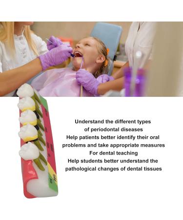 Realistic Dental Periodontitis Model - Study Dental Teeth in Various Stages | Synthetic Resin Educational Tool - Buy Online on GoSupps.com