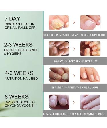 Nail Repair Pen and Natural Formula 3ml Ingrown Nail Solution Cracked Nail Repair Fast Absorption for Cleaning Ingrown Damaged Cracked Men - Buy Online on GoSupps.com