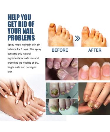 Furzero Nail Fungus & Athlete's Foot Treatment Spray - Medical Grade Anti-Itch Relief (3pcs) - Buy Online on GoSupps.com