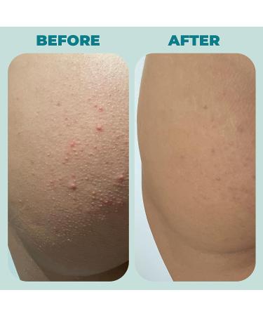 Miami Beach Bum Mint Bum + Body Cream 6oz - Daily Moisturizer for Skin Health, Acne Treatment, Razor Bumps, Ingrown Hairs, Sunburns, Blemishes - After Sun Lotion - Buy Online on GoSupps.com