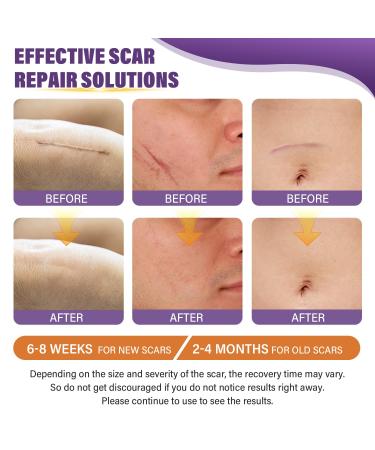 Silicone Scar Sheets & Tape | Effective Scar Removal for Surgical & Keloid Scars - 1.6 x 59 Roll (1.5M) - Fast International Shipping - Buy Online on GoSupps.com