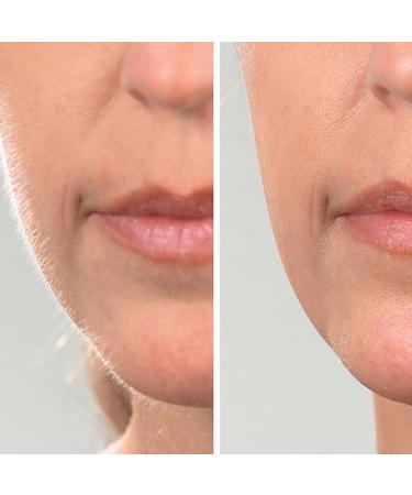 Magnitone DermaQueen Vibra-Sonic Facial Hair Removal & Dermaplane Exfoliator Radiant Skin, Hair Removal & Exfoliation with Vibra-Sonic Technology - Buy Online on GoSupps.com