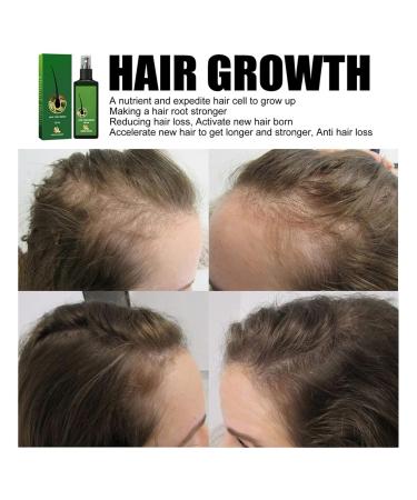 Qiaogeli Hair Growth Serum - Accelerate Growth Thicker Hair Anti-Hair Loss for Men & Women - 1.01 fl. oz. - Buy Online on GoSupps.com