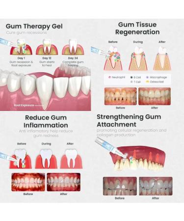 Gum Shield Therapy Gel Gum Gel Gum Shield Therapy Gel and Whitening Instant Teeth Whitening Essence Pen Deeply Cleaning Gums Enhances Overall Gum Health(3PCS) - Buy Online on GoSupps.com
