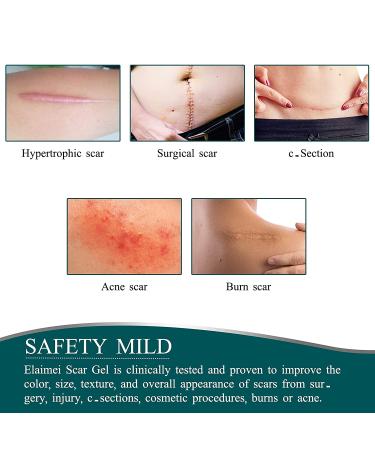 Silicone Scar Sheets Roll (1.6 x 120) for Scar Removal - Professional Grade Strips for Surgery, C-Section, Burn, Acne, Keloid - Safe & Reusable - Buy Online on GoSupps.com