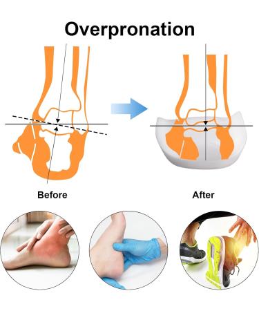3/4 Arch Support Orthotics for Plantar Fasciitis Relief - Metatarsal Insoles for Over-Pronation Foot Pain & Morton s Neuroma - For Men Size 9-12 & Women Size 11-14 - Buy Online on GoSupps.com