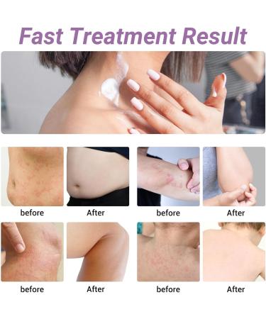 Urticaria Cream - Fast Relief for Hives Allergic Rashes & Itchy Skin | All-Natural Herbal Formula - 3.53 Oz - Buy Online on GoSupps.com