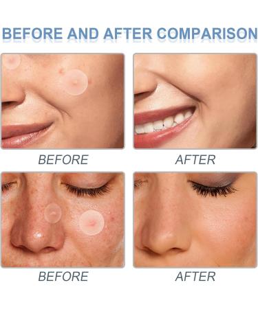 Acne Pimple Patches - Absorbing Cover with Tea Tree Oil Invisible Blemish Spot Hydrocolloid Skin Treatment Facial Stickers Five Sizes Blends in with skin - Buy Online on GoSupps.com