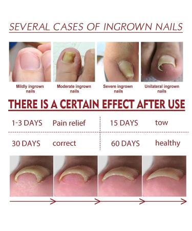 2Pcs German Toenailplus Anti Paronychia Relief Oil - Ingrown Toenail Treatment & Pain Relief for Damaged Thick Nails - Buy Online on GoSupps.com