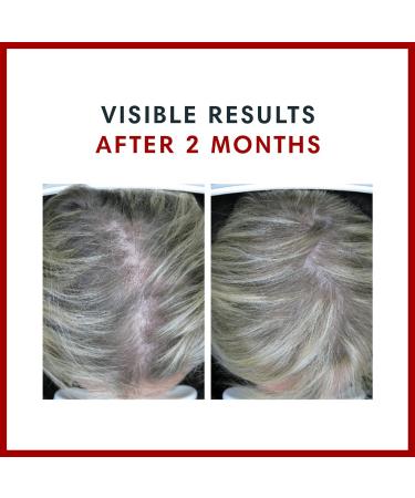 Consult Health BIOTIN GAIN Gummies with ANAGAIN - Reduce Hair Loss - Clinically Tested - 10 000 mcg Biotin Vitamin B7 to Support Healthy Hair Growth Skin and Nails for Women and Men - 60 Count - Buy Online on GoSupps.com