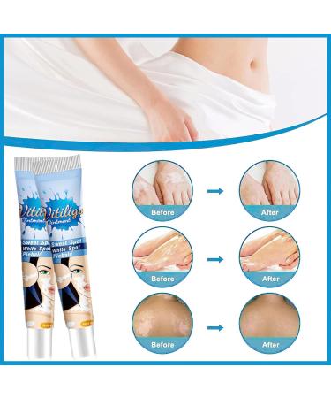 MIELIKKI Vitiligo Cream | Reduce White Spots & Enhance Skin Pigmentation | Natural Vitiligo Care Cream for All Skin Types - Buy Online on GoSupps.com