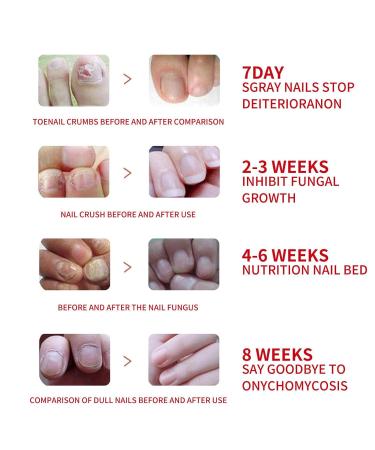 Shop Nail Growth Oil & Repair Fluid - Nourishing Nail Hardener & Moisturizer for Healthy Cuticles - Buy Online on GoSupps.com